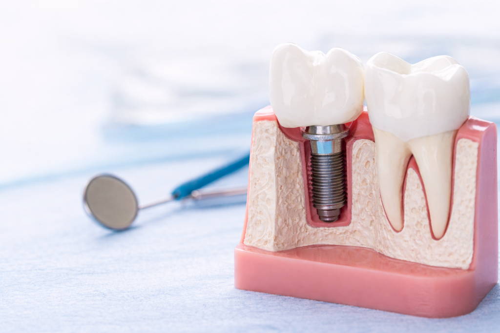 Signs You May Need Dental Implants 1 Dental implant model showing titanium post and crown replacing a missing tooth